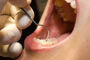 歯茎の中の歯石取り